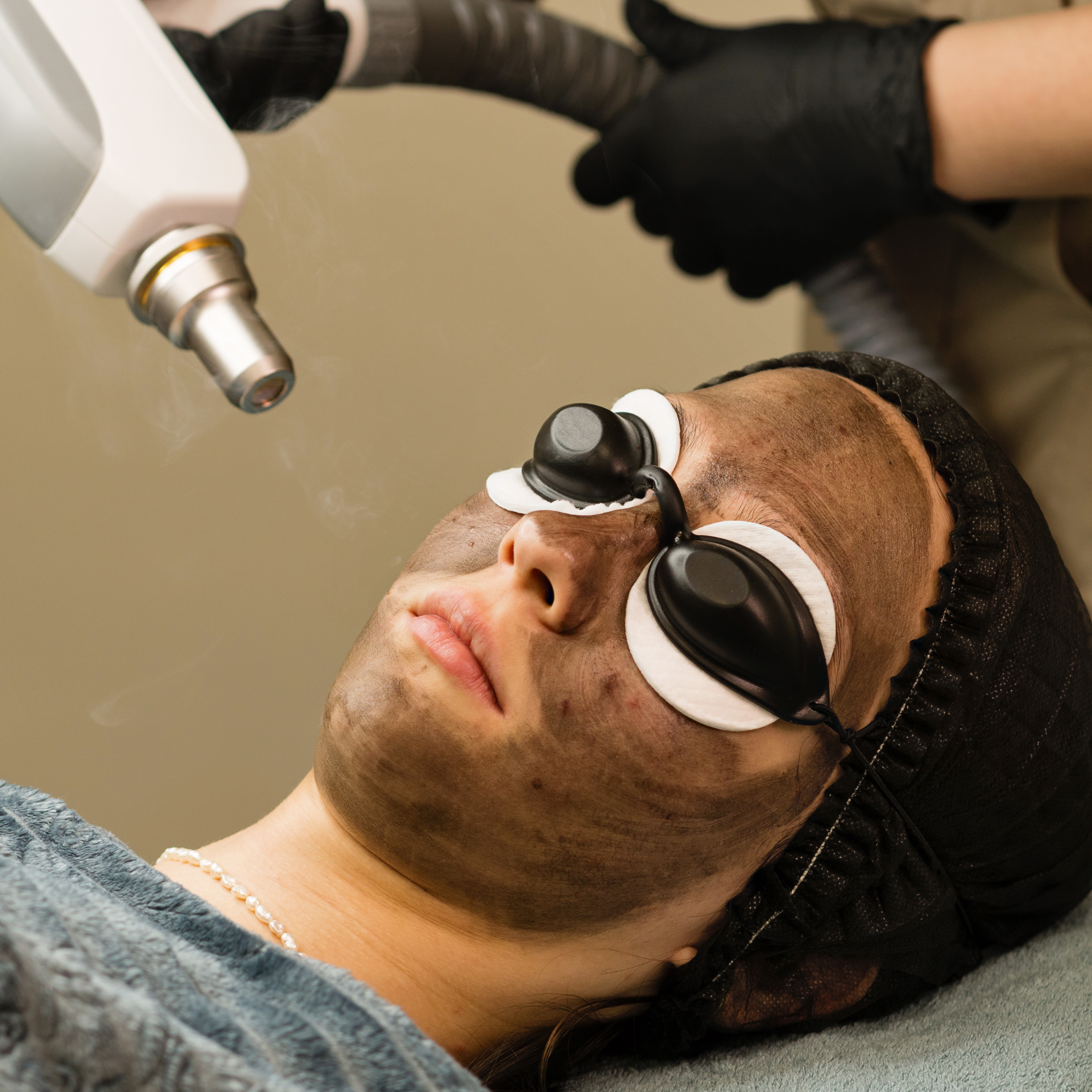 Chemical Peel